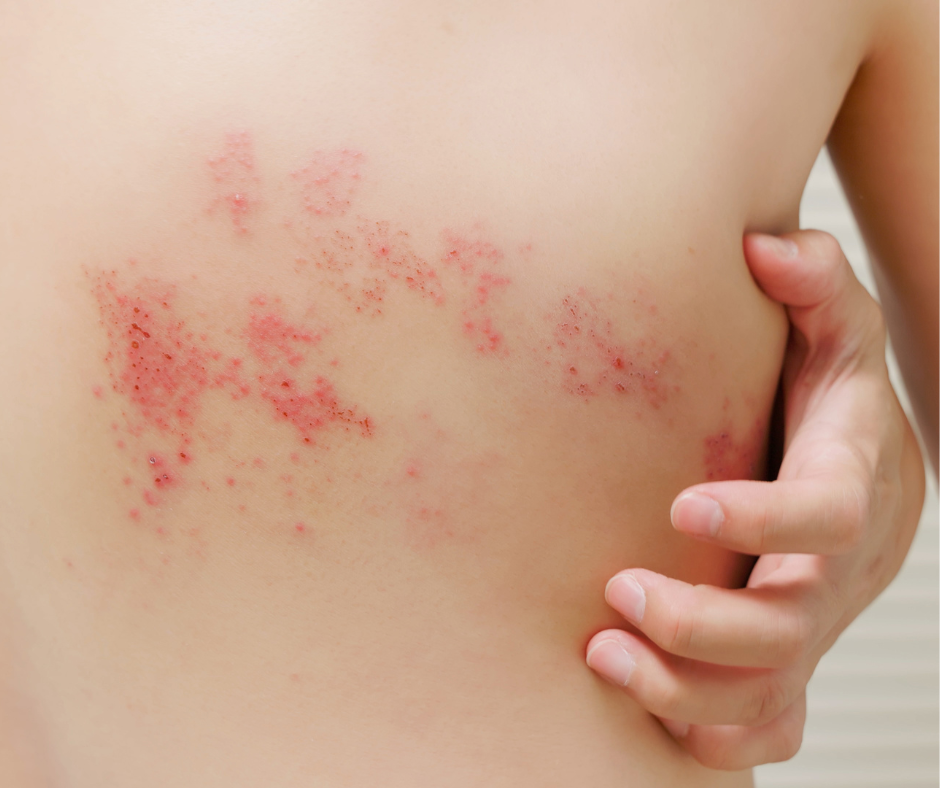 Fuoco di Sant’Antonio (herpes zoster)